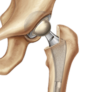 Hip Replacement