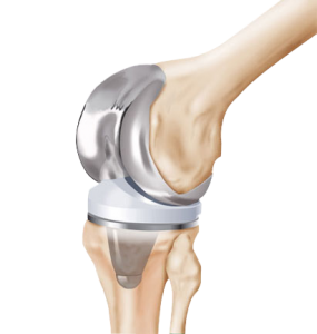 Knee Replacement